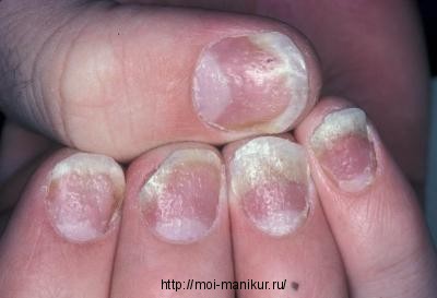 Псориаз ногтей - симптомы и лечение.