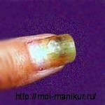 Псевдомоны - позеленевшие ногти.