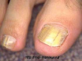 Заболевание кондидоз ногтей на ногах.